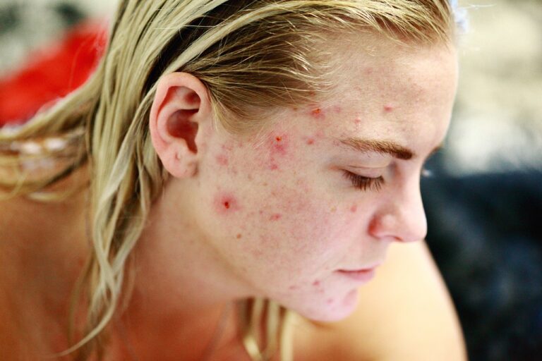 4 Tips om te proberen bij last van acne